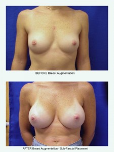 Before & After Breast Augmentation 1- Sub-Fascial Placement, Clearwater, Fl.