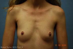 Front View: Breast Augmentation before photo