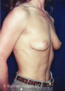 Breast augmentation | before photo | right oblique view