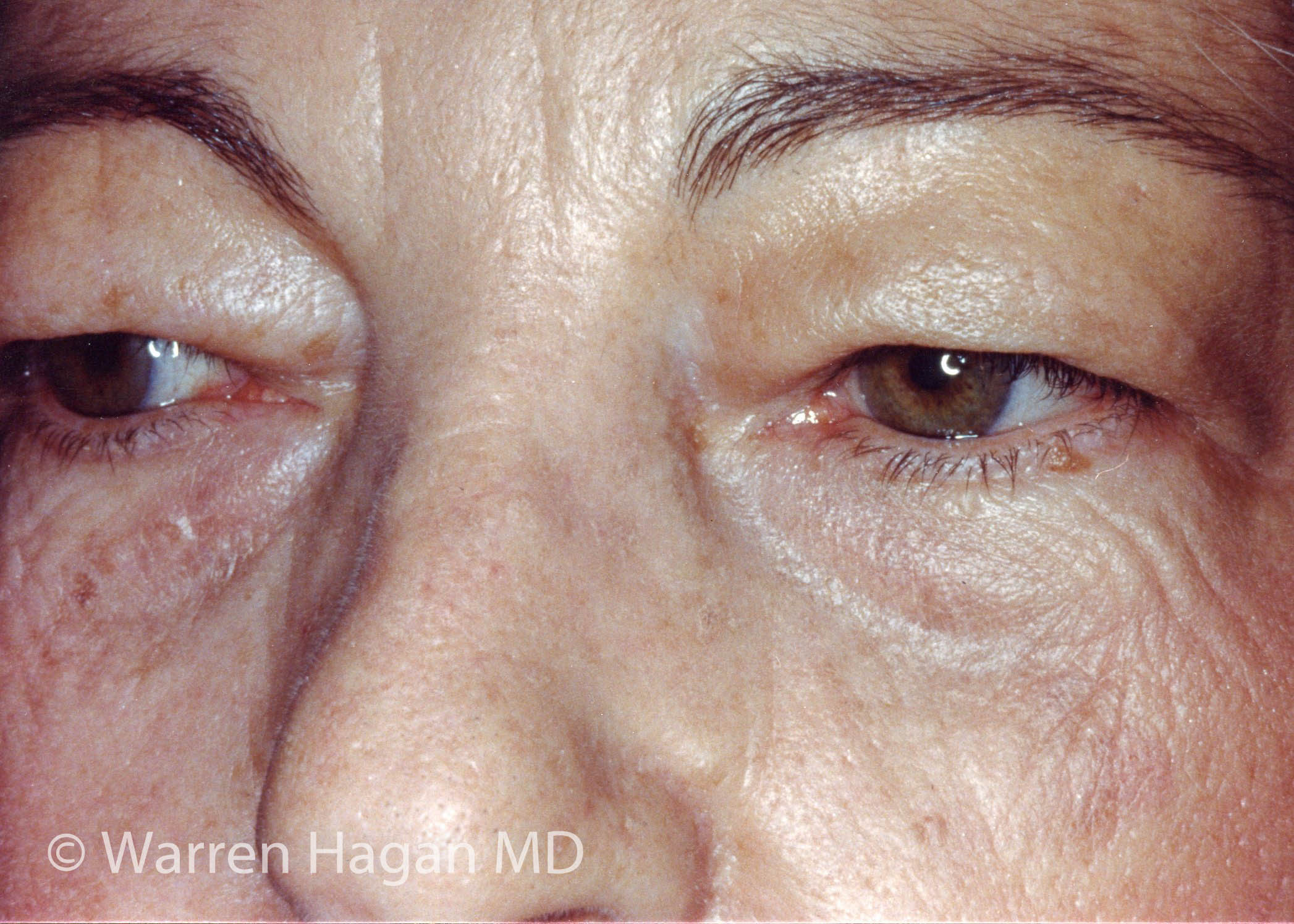 Blepharoplasty - Eyelids - before photo - left oblique view