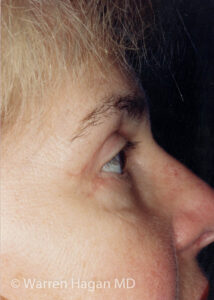 Blepharoplasty - Eyelids - after photo - right lateral view