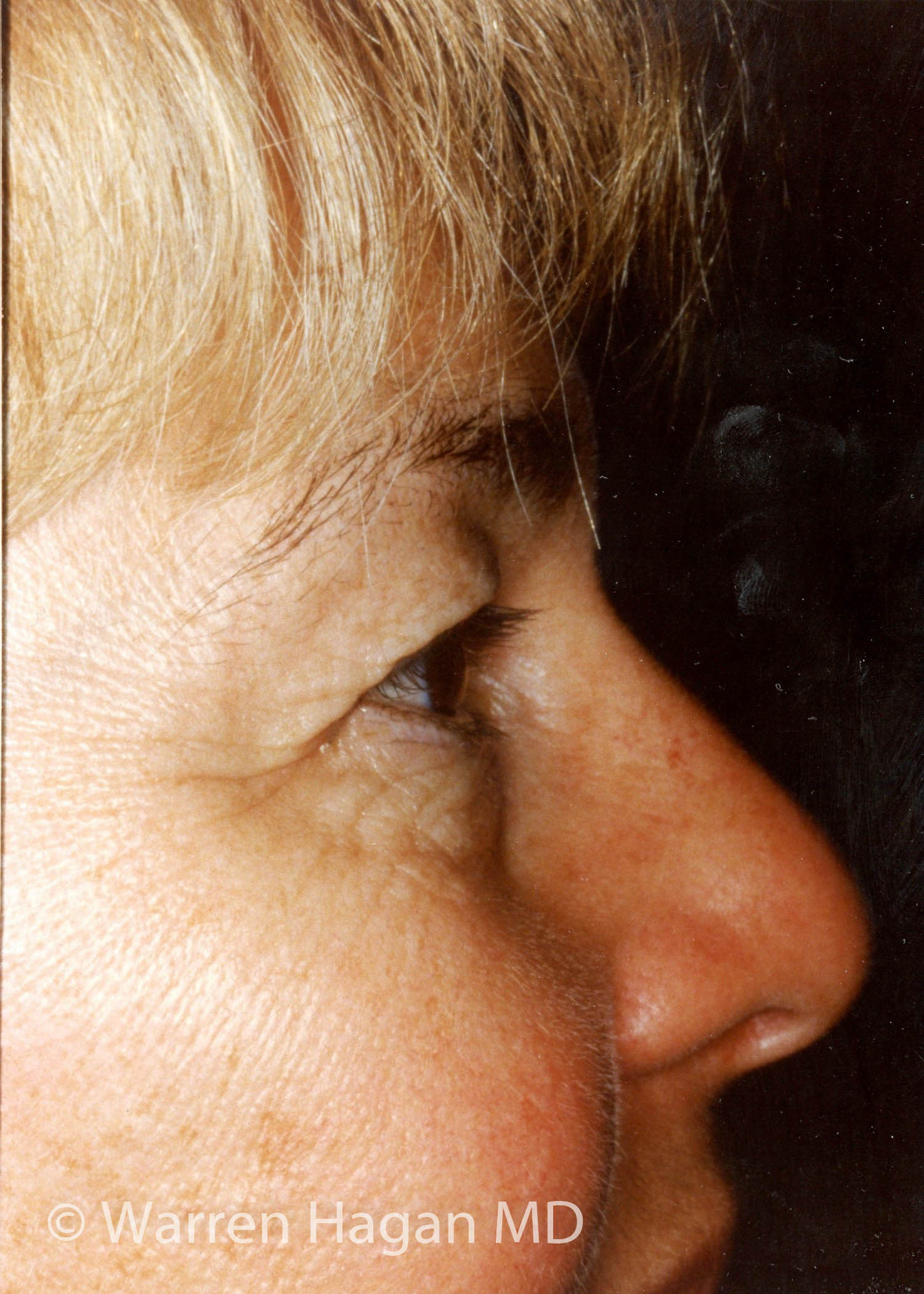 Blepharoplasty - Eyelids - before photo - right lateral view