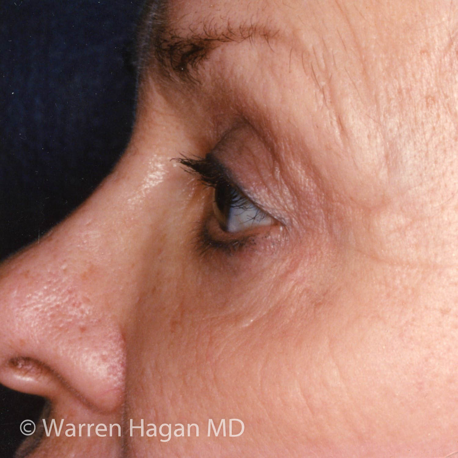 Blepharoplasty - Eyelids - after photo - left lateral