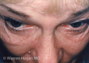 Blepharoplasty - Eyelids - before photo - down view