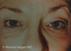 Blepharoplasty - Eyelids - before photo - straight