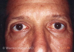 Blepharoplasty - Eyelids - after photo - straight view