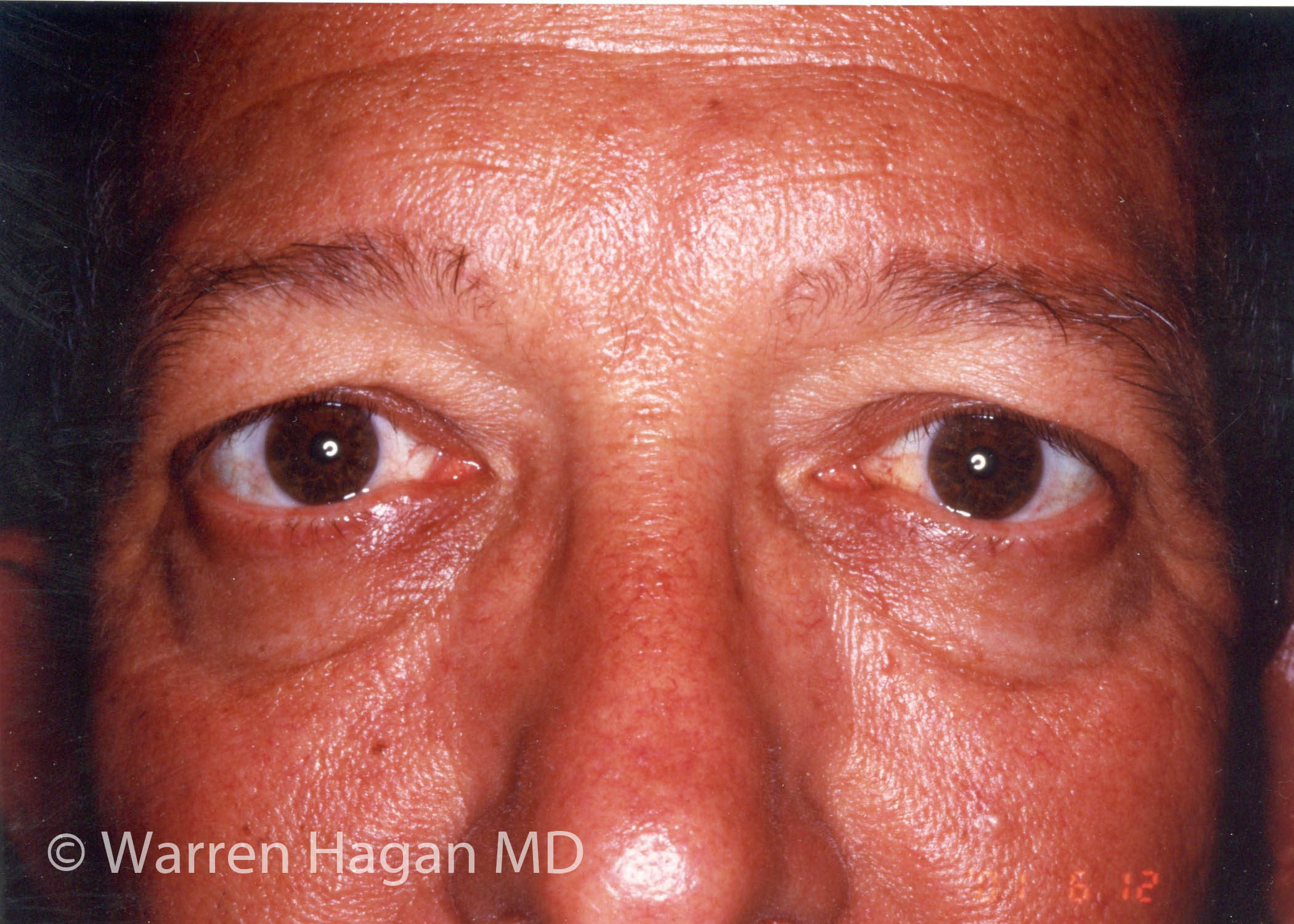 Blepharoplasty - Eyelids - before photo - straight view
