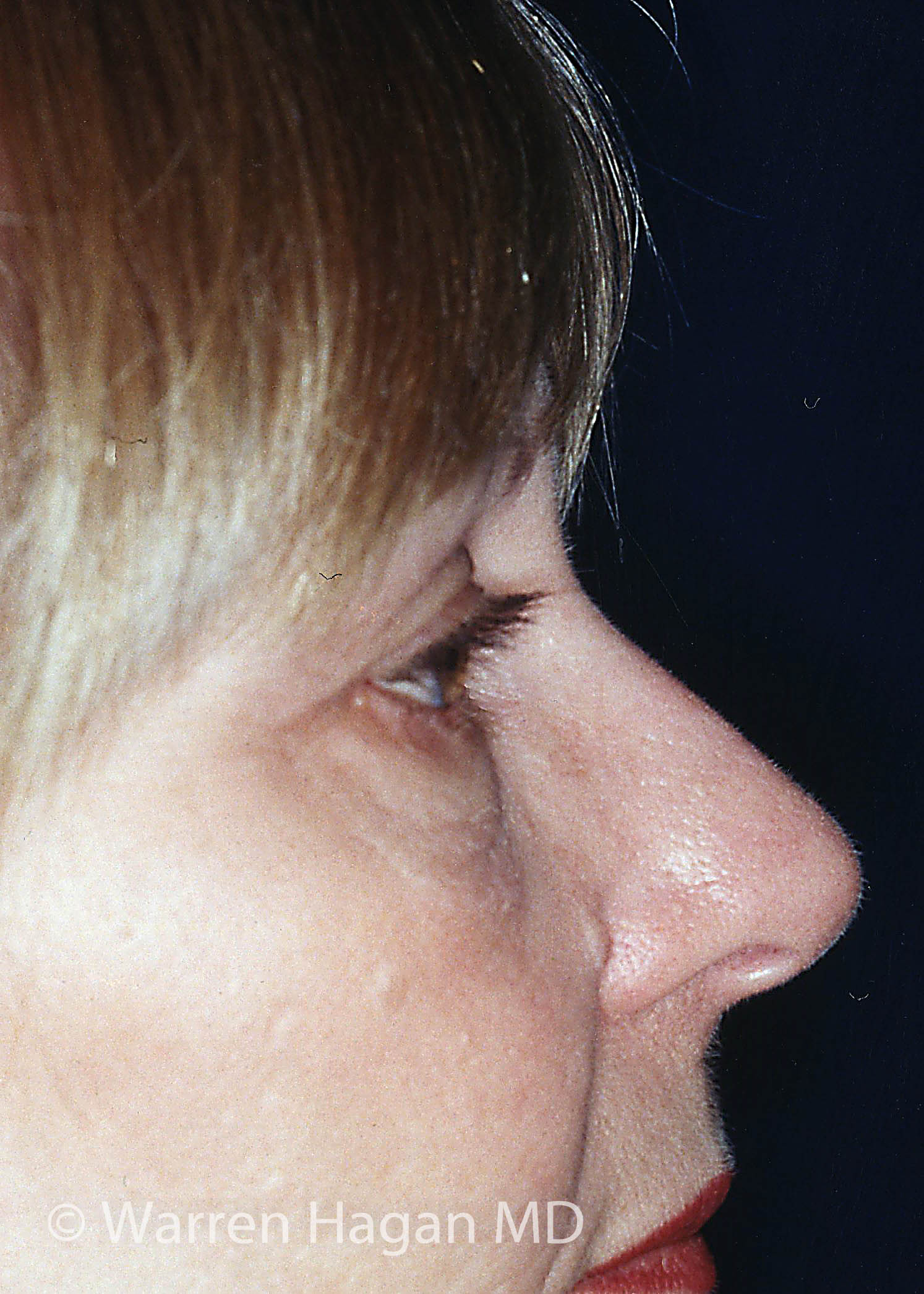 Blepharoplasty - Eyelids - before photo - right lateral view