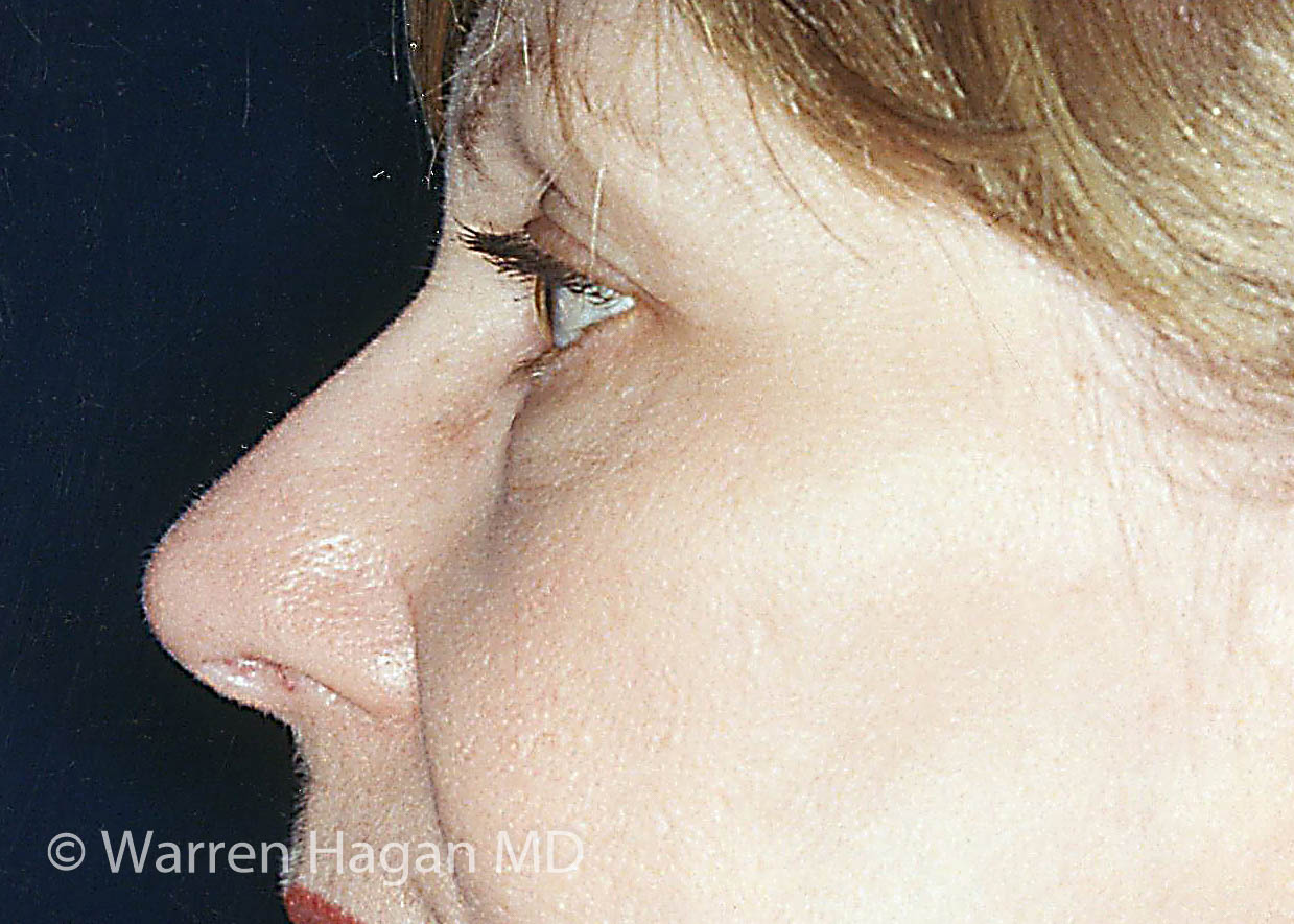 Blepharoplasty - Eyelids - before photo - left lateral view