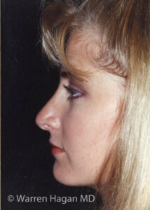 Rhinoplasty | after photo | left lateral view