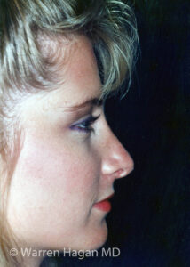 Rhinoplasty | after photo | right lateral view