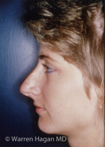 Rhinoplasty | before photo | left lateral view