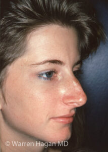 Rhinoplasty | before photo | right oblique view
