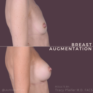 breast augmentation, right lateral view