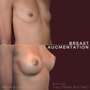 breast augmentation, right oblique view