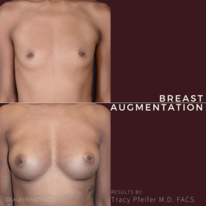breast augmentation, straight view
