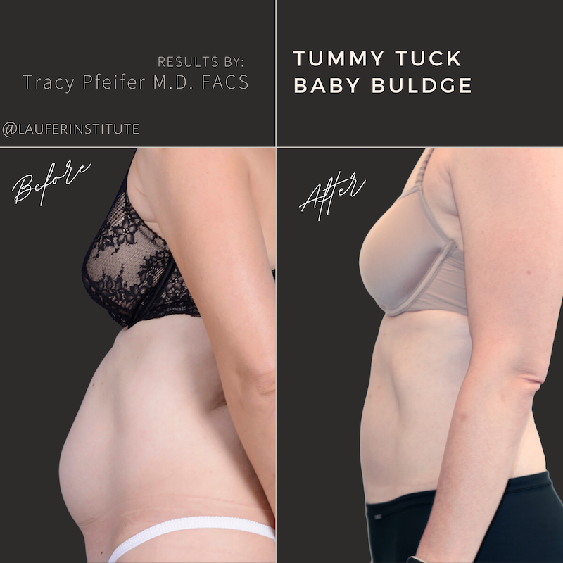 Tummy Tuck left lateral view