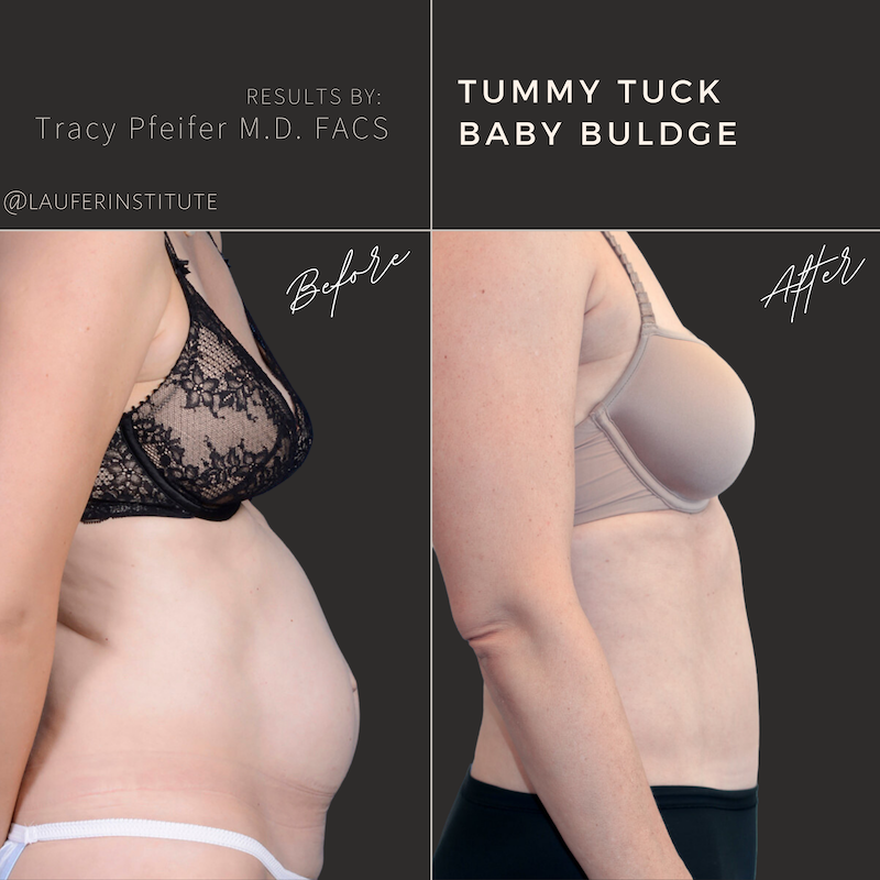 Tummy Tuck right lateral view