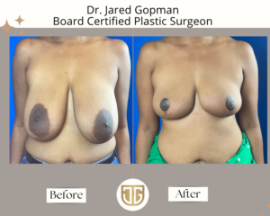 Breast Reduction - front view - Dr Jarod Gopman