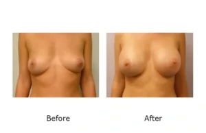 Breast Augmentation