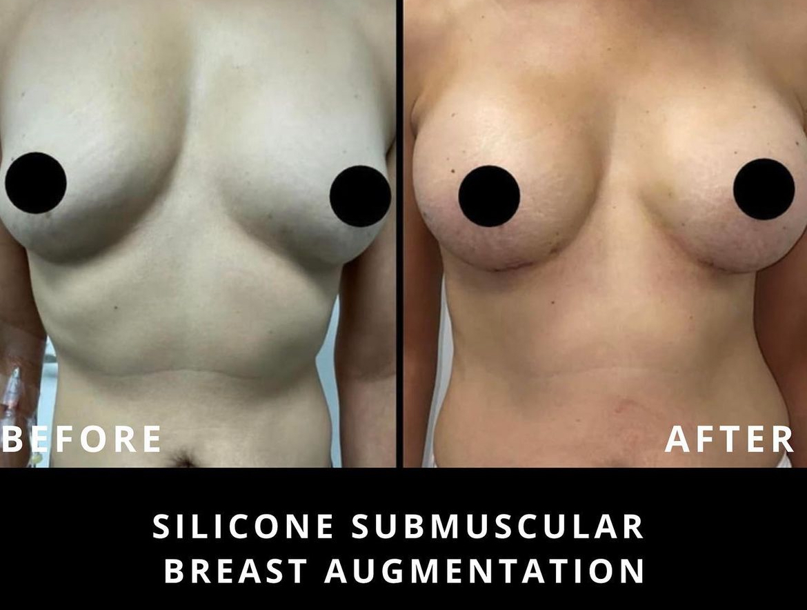 breast augmentation - silicone sub muscular
