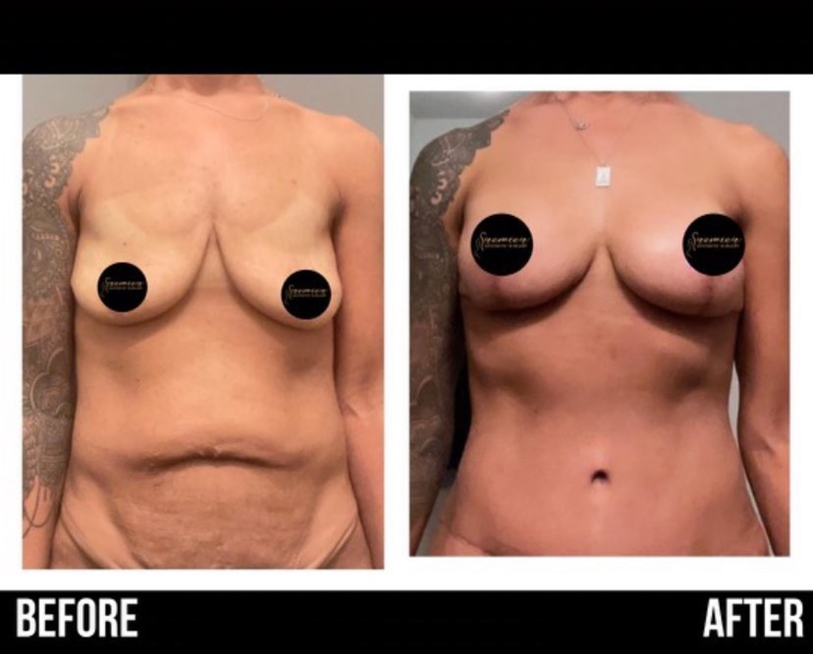 breast augmentation front view - before and after