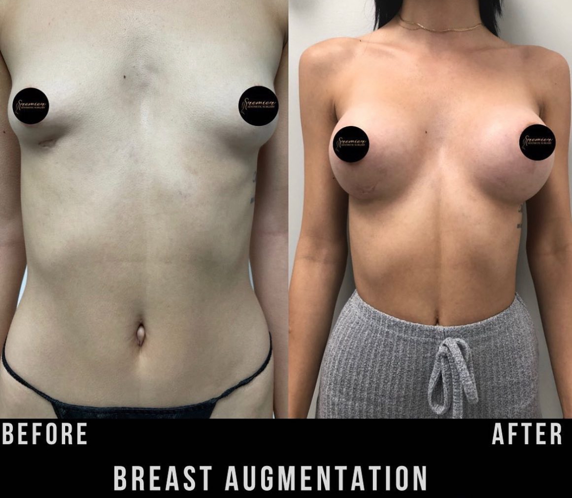 breast augmentation