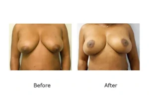 Breast Lift