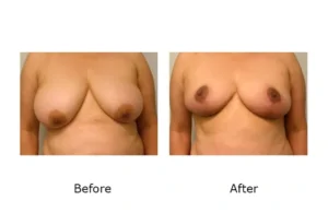 breast reduction