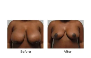 breast reduction