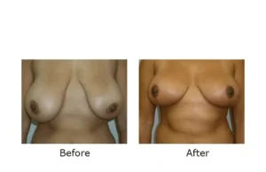 breast reduction