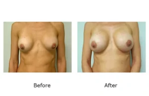 Breast Revision