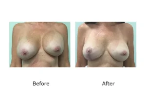 Breast Revision