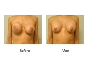 Breast Revision