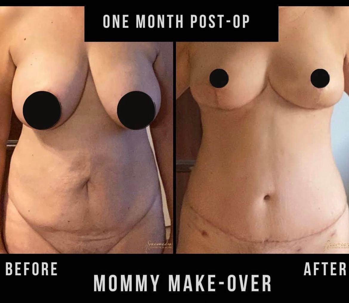 Mommy Makeover