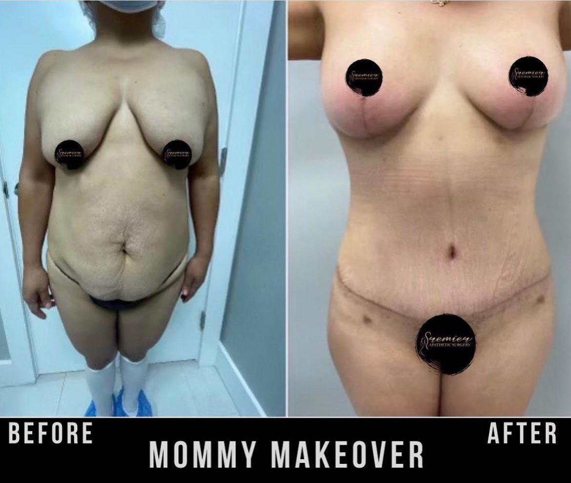 Mommy Makeover