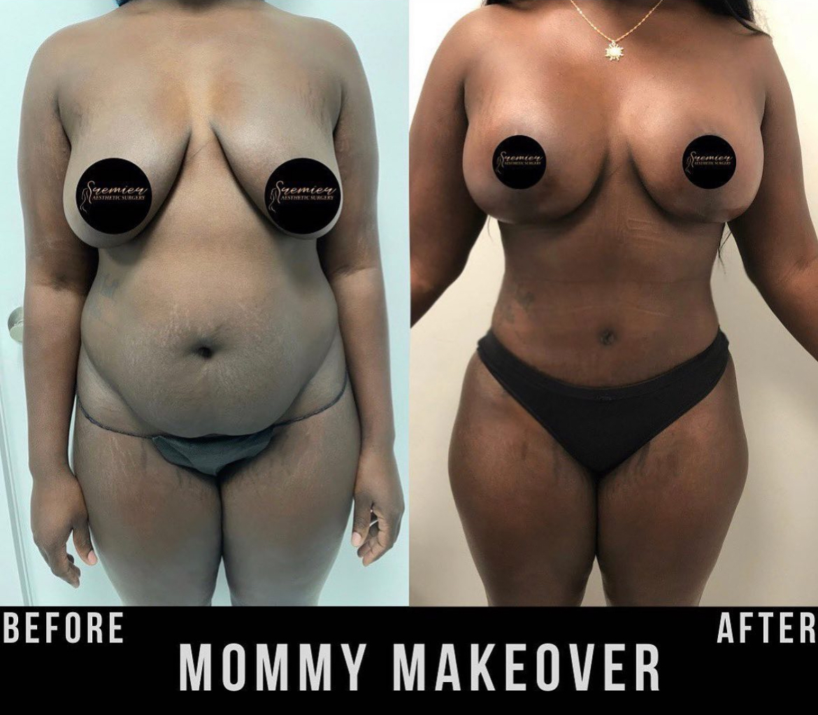 Mommy Makeover