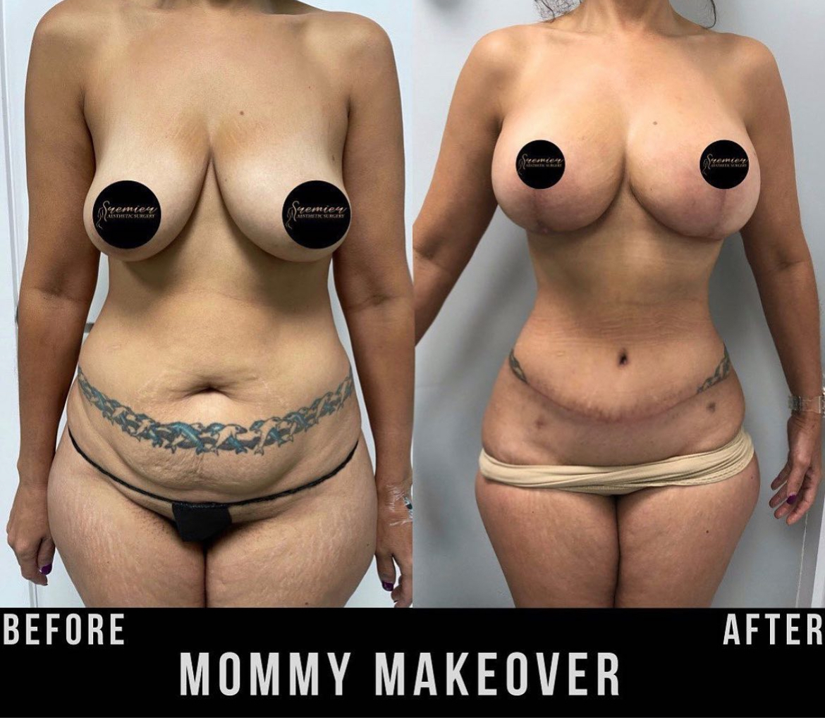 Mommy Makeover