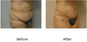 Tummy Tuck