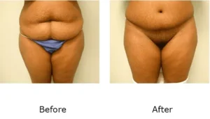 Tummy Tuck