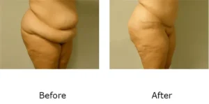 Tummy Tuck